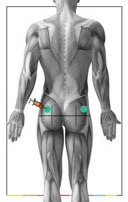 Как сделать укол в мышцу: внутримышечная инъекция инструкция. 